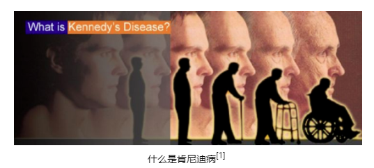 【罕見病并不罕見】肯尼迪病(KD)—漫長(zhǎng)的“漸凍癥”